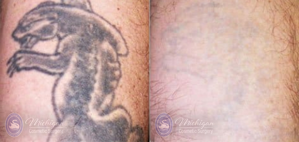 Laser Tattoo Removal Before and After Photo by Dr. Awada in Southfield Michigan
