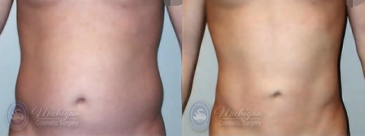 Liposuction Before and After Photo by Dr. Awada in Southfield Michigan