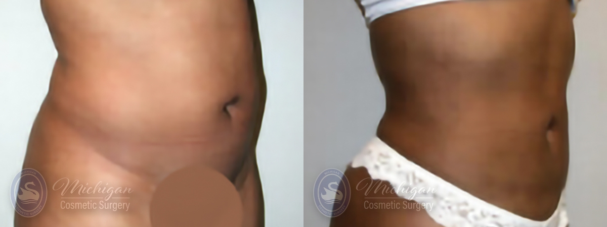 Liposuction Before and After Photo by Dr. Awada in Southfield Michigan