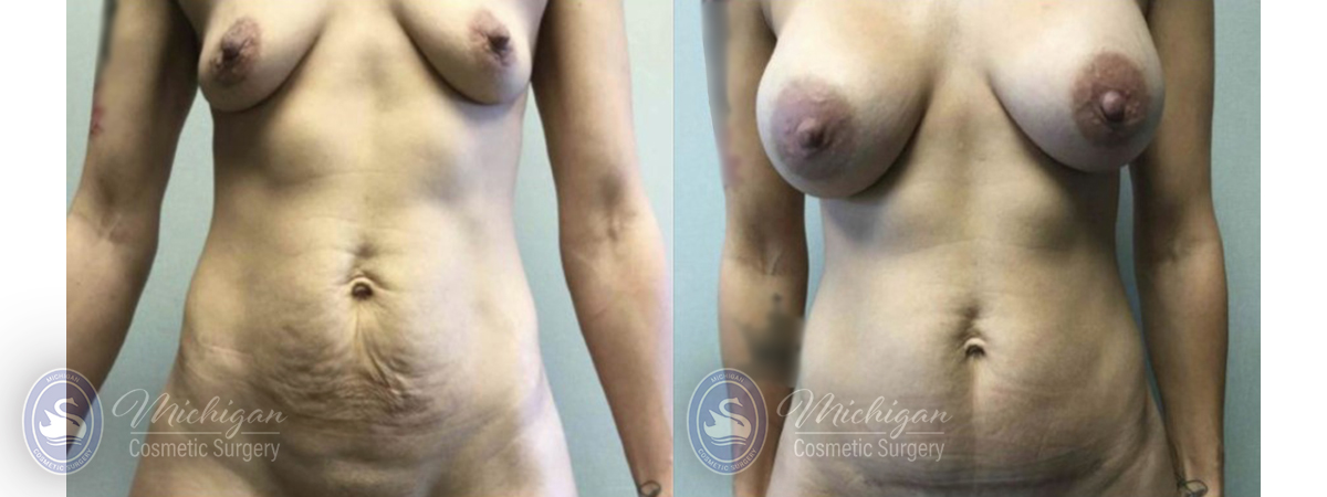 Mommy Makeover Before and After Photo by Dr. Awada in Southfield Michigan