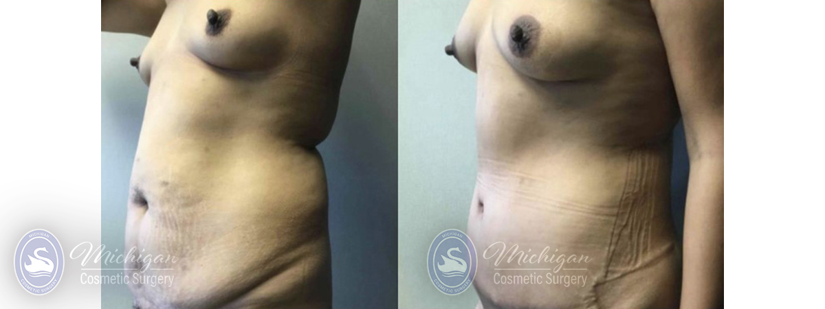Mommy Makeover Before and After Photo by Dr. Awada in Southfield Michigan