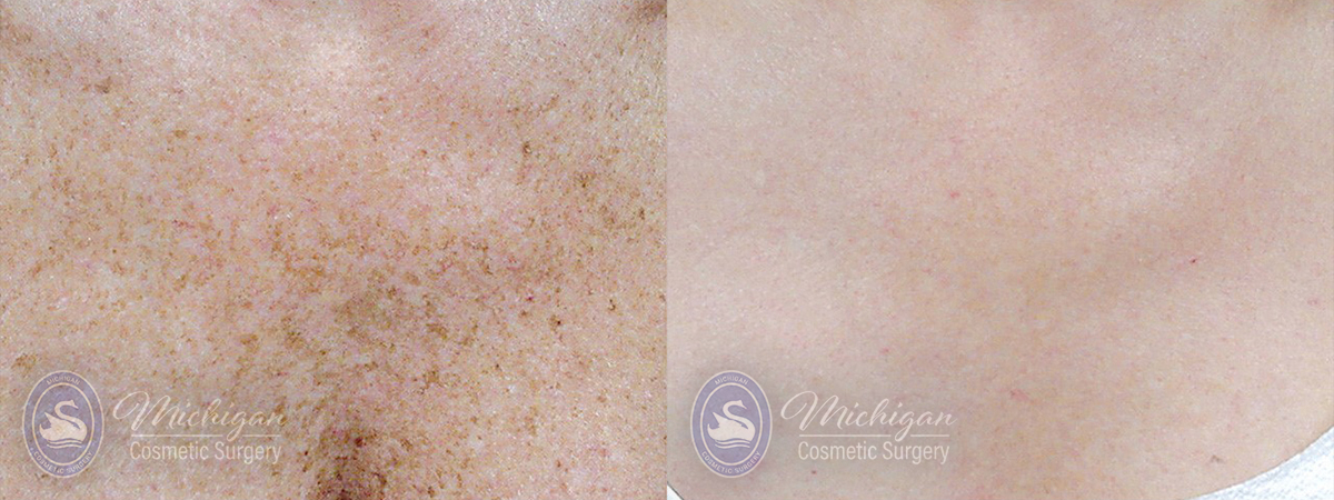 Pigment & Redness Before and After Photo by Dr. Awada in Southfield Michigan