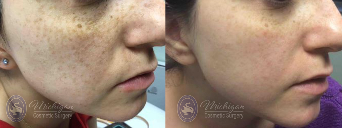 Pigment & Redness Before and After Photo by Dr. Awada in Southfield Michigan