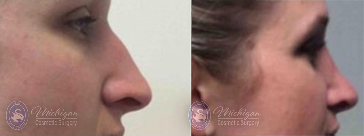 Rhinoplasty Before and After Photo by Dr. Awada in Southfield Michigan