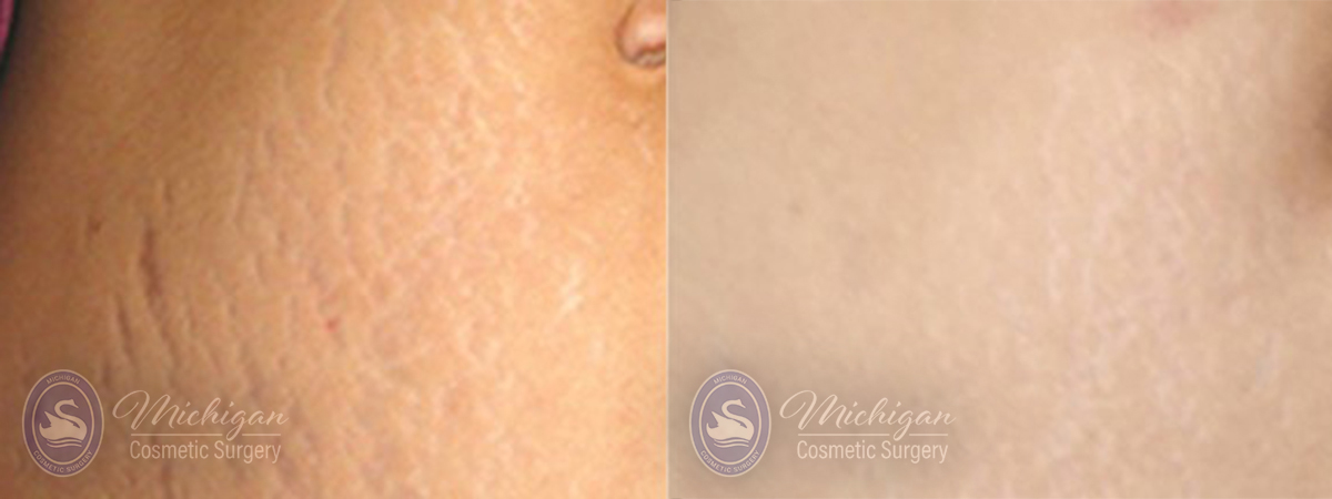 Stretchmark Removal Before and After Photo by Dr. Awada in Southfield Michigan
