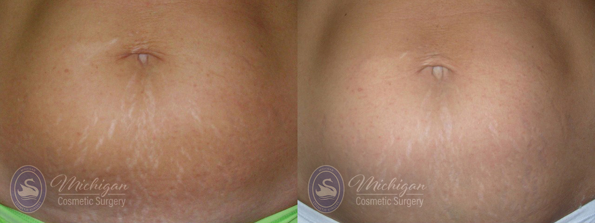 Stretchmark Removal Before and After Photo by Dr. Awada in Southfield Michigan