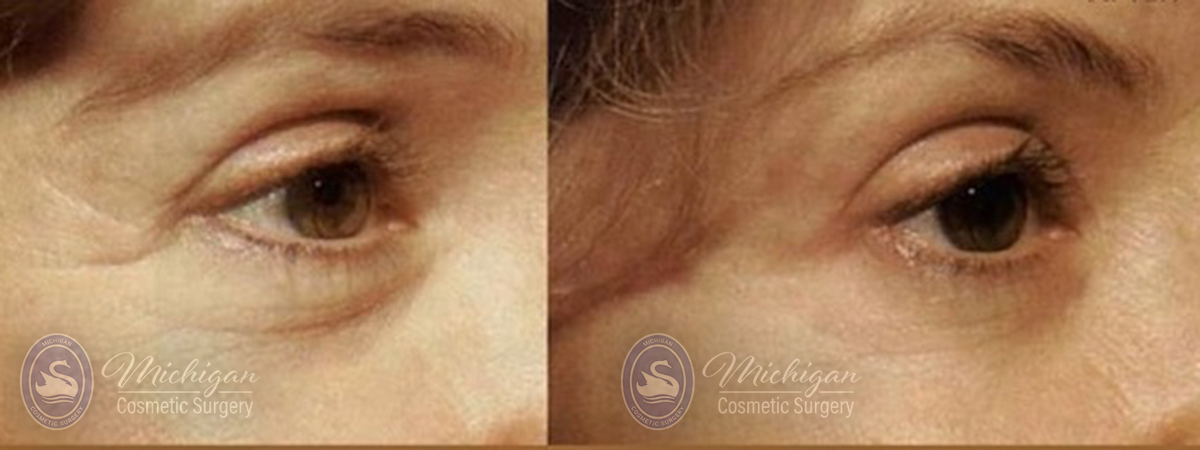 Thermi Smooth Before and After Photo by Dr. Awada in Southfield Michigan