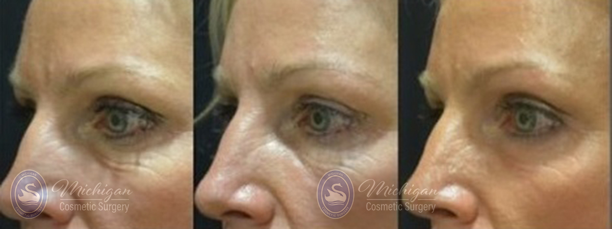 Thermi Smooth Before and After Photo by Dr. Awada in Southfield Michigan