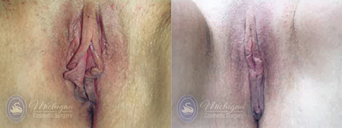 ThermiVa Before and After Photo by Dr. Awada in Southfield Michigan