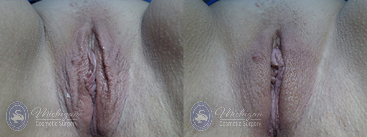 ThermiVa Before and After Photo by Dr. Awada in Southfield Michigan