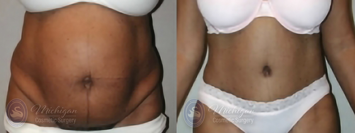 Tummy Tuck Results Southfield Michigan