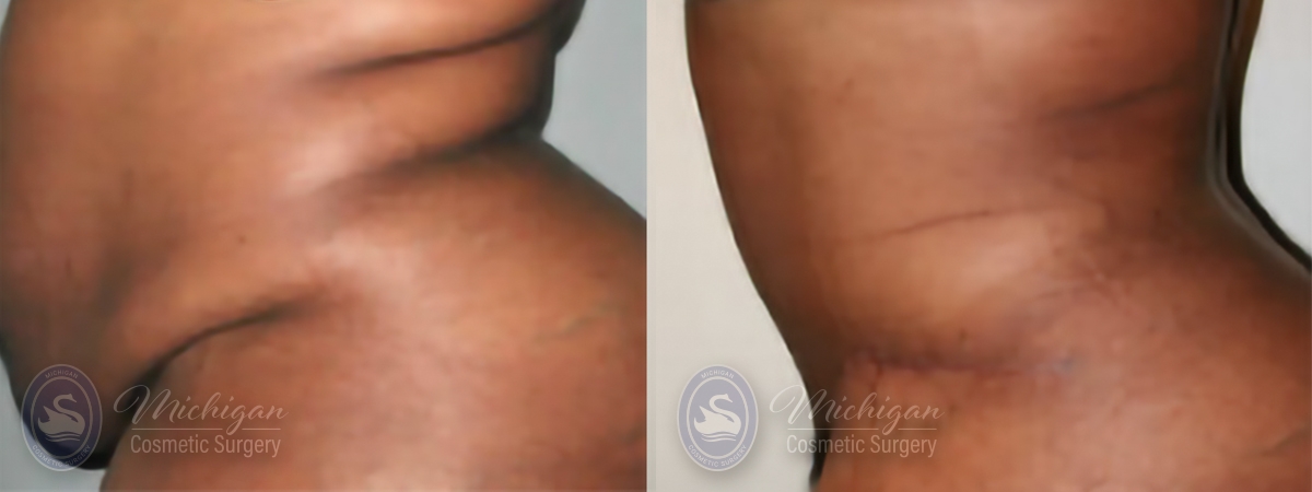 Tummy Tuck Before and After Photo by Dr. Awada in Southfield Michigan