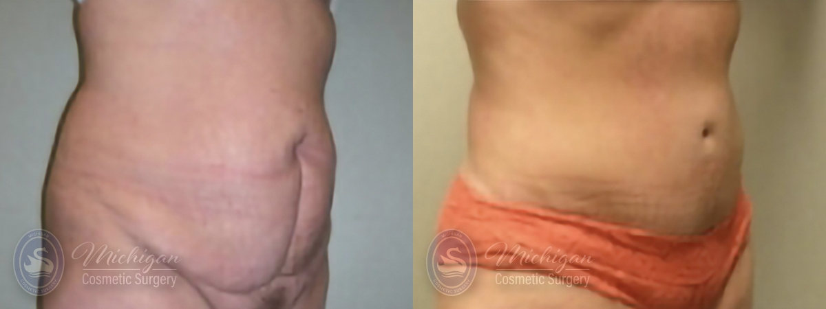Tummy Tuck Before and After Photo by Dr. Awada in Southfield Michigan
