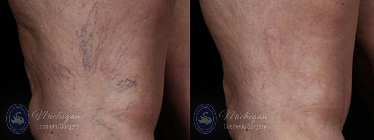 Vein Removal Before and After Photo by Dr. Awada in Southfield Michigan