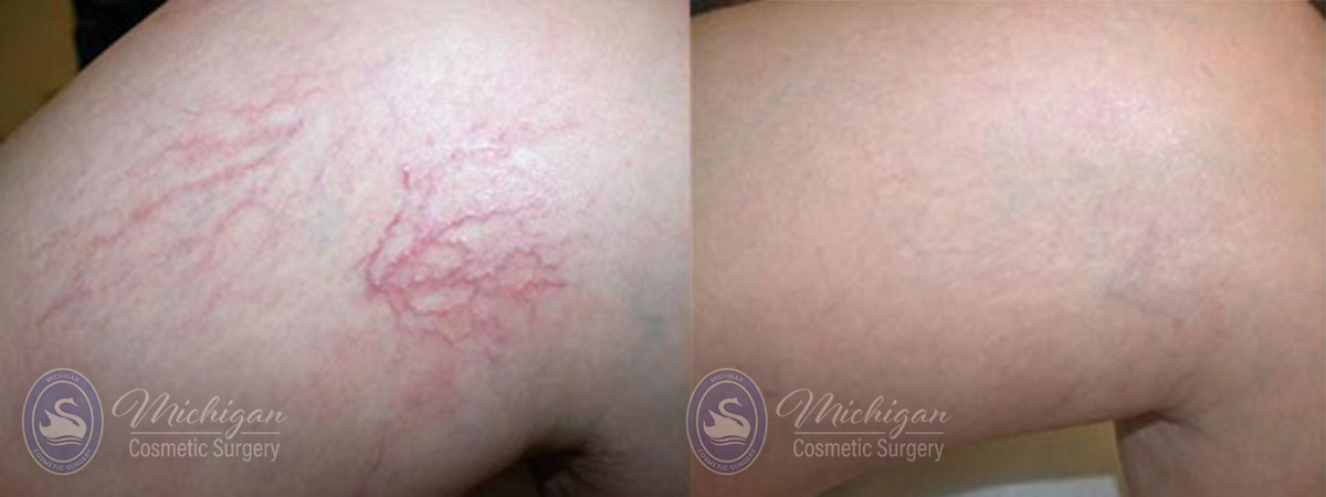 Vein Removal Before and After Photo by Dr. Awada in Southfield Michigan