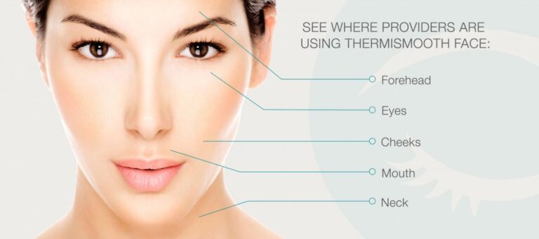 ThermiSmooth Treatment Areas