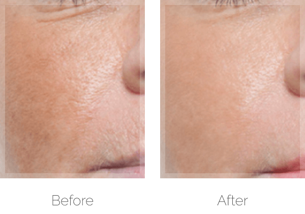 PRP Therapy before & after photo