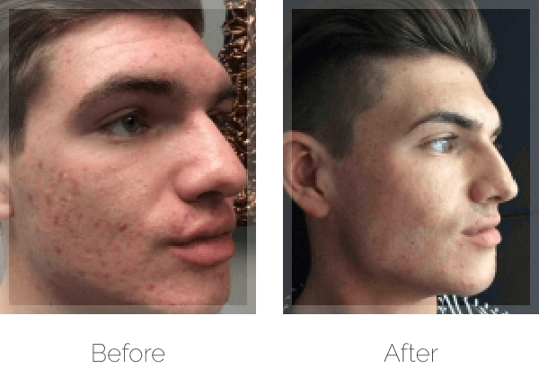 Acne treatment before & after photo