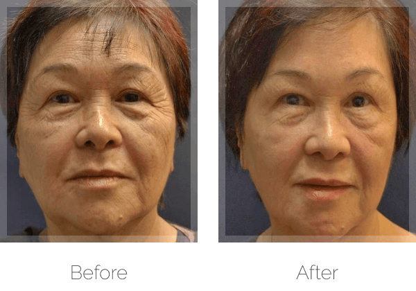 Non-Surgical Anti-Aging Before & After