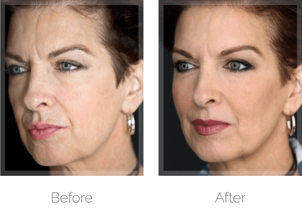 Botox Before & After Photo