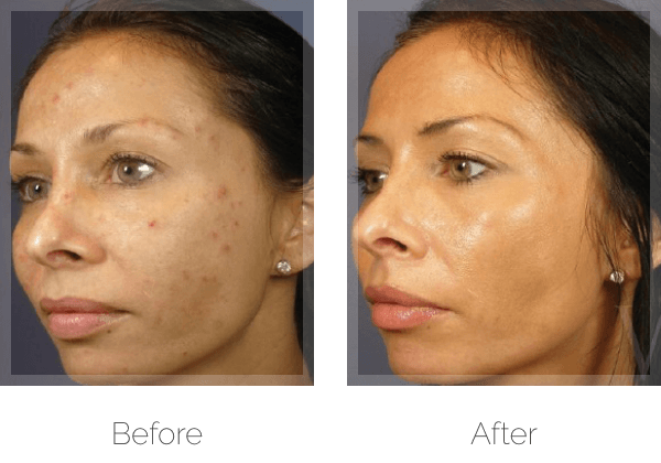 Chemical Peels Before & After