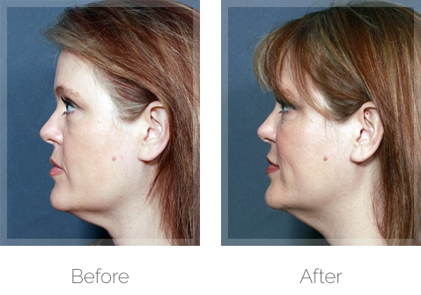 Non-Surgical Skin Tightening Before and After Photo by Dr. Awada in Southfield Michigan