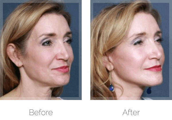 Silhouette Insta-Lift before & after