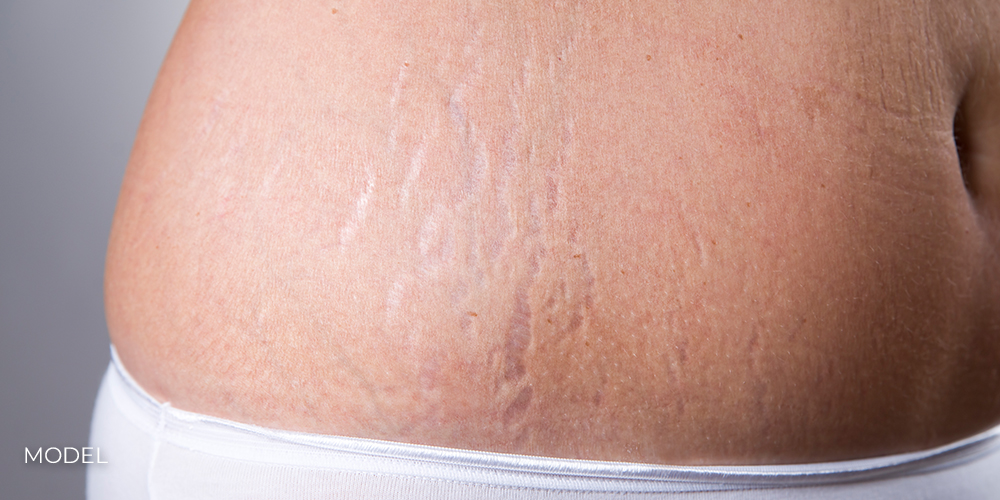 Forehead & Eyebrow Lift By Dr. Mariam Awada Female belly with stretch marks closeup on a gray background