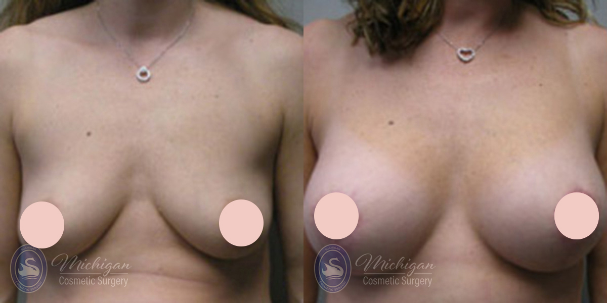 Before and After Breast Augmentation Medium Lift
