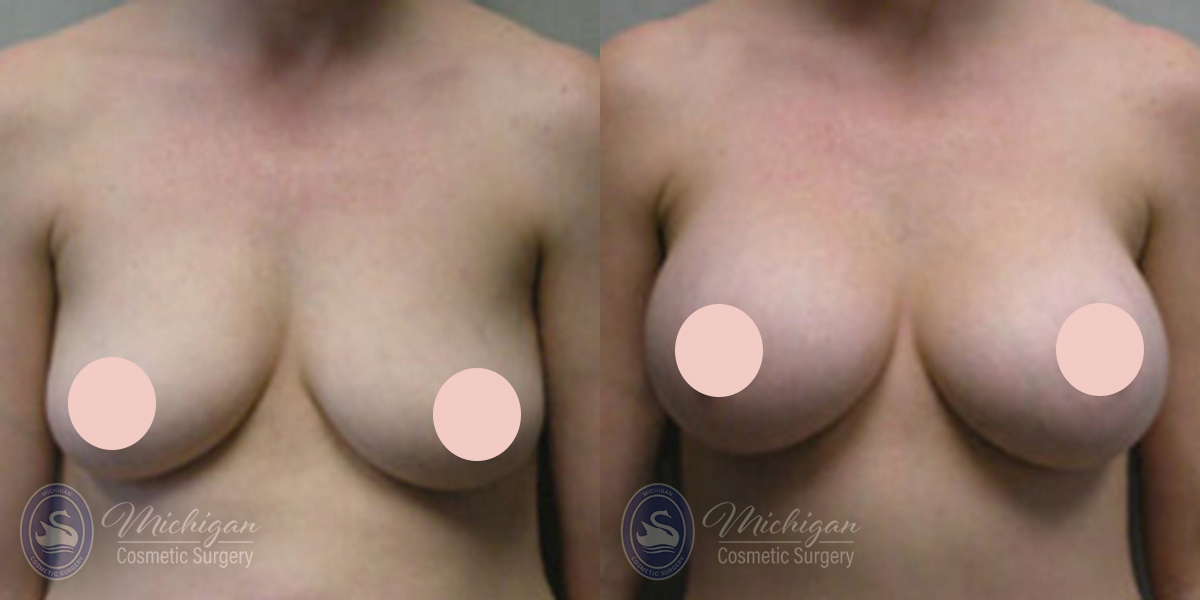 Before After Breast Augmentation with Small Lift