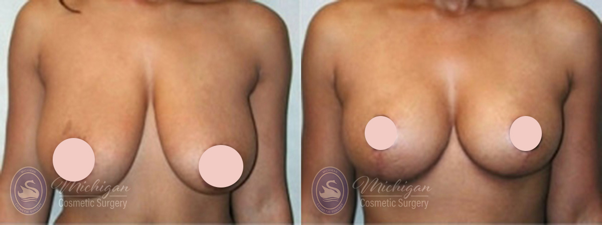 Michigan-Cosmetic-Surgery-Southfield-Breast-Lift-Bxa