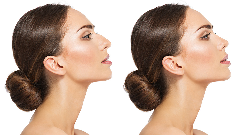 Rhinoplasty Michigan