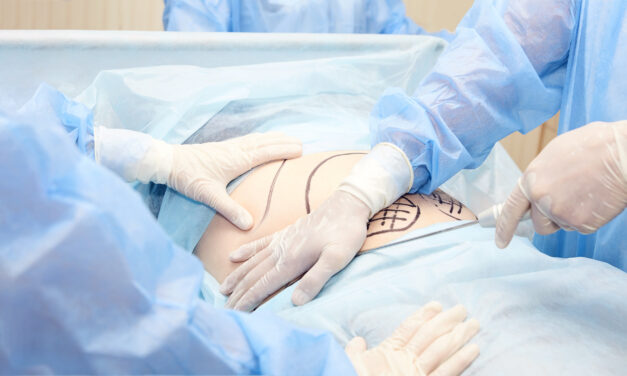 Liposuction Recovery Tips for Faster Healing