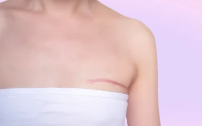 Reclaiming Your Body After Breast Cancer