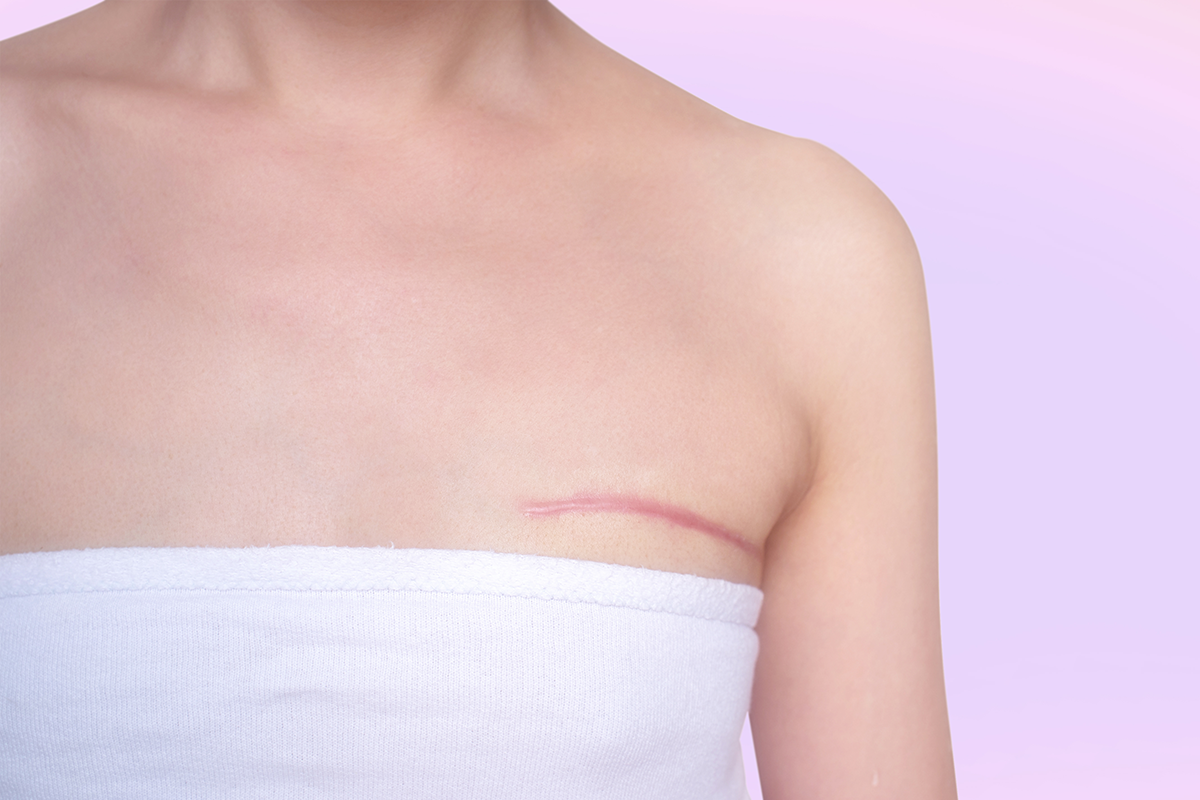 breast cancer surgery scars by partial mastectomy breast cancer surgery scars by partial mastectomy