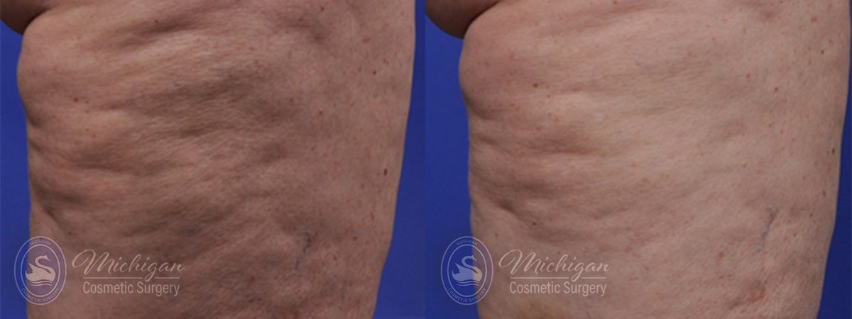 cellulite before after image cellulite before after image