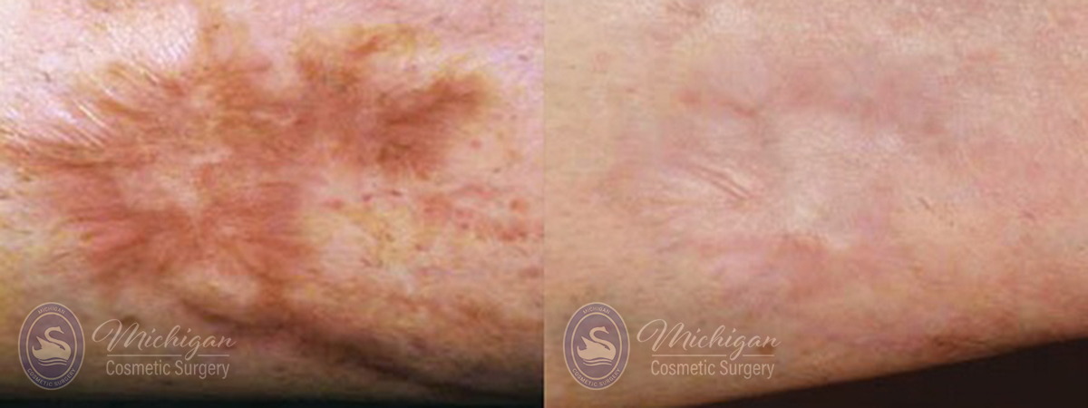 laser scar removal before after image