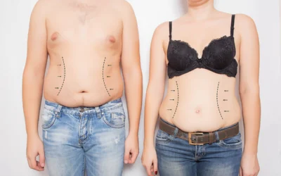3 Important Factors to Consider About Liposuction