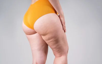 The Truth About Liposuction and Cellulite – Part 1