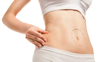 Is Liposuction Right for Me?