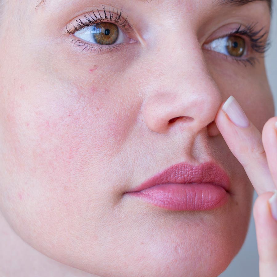 Young woman with rosacea problem on face