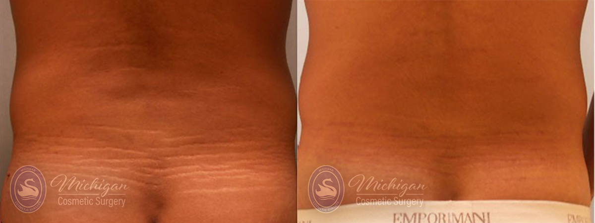 stretch mark before and after image