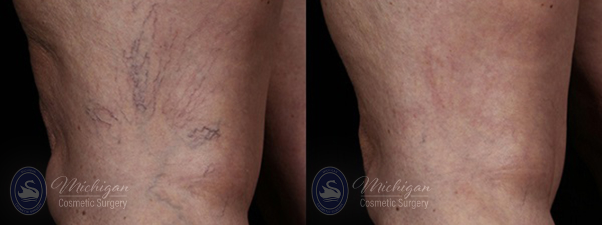 vein removal before after image