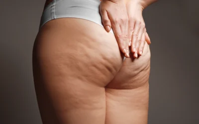 The Fight Against Cellulite – Part 2