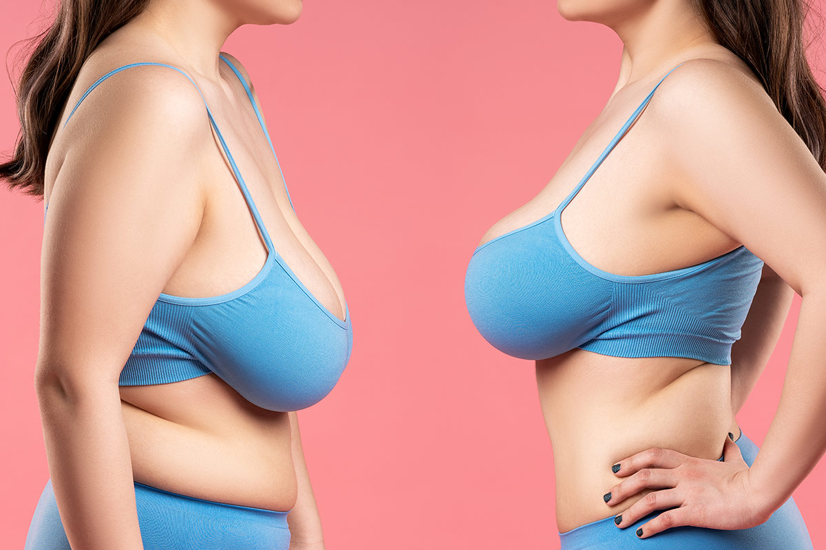 woman with very large silicone breasts after correction surgery