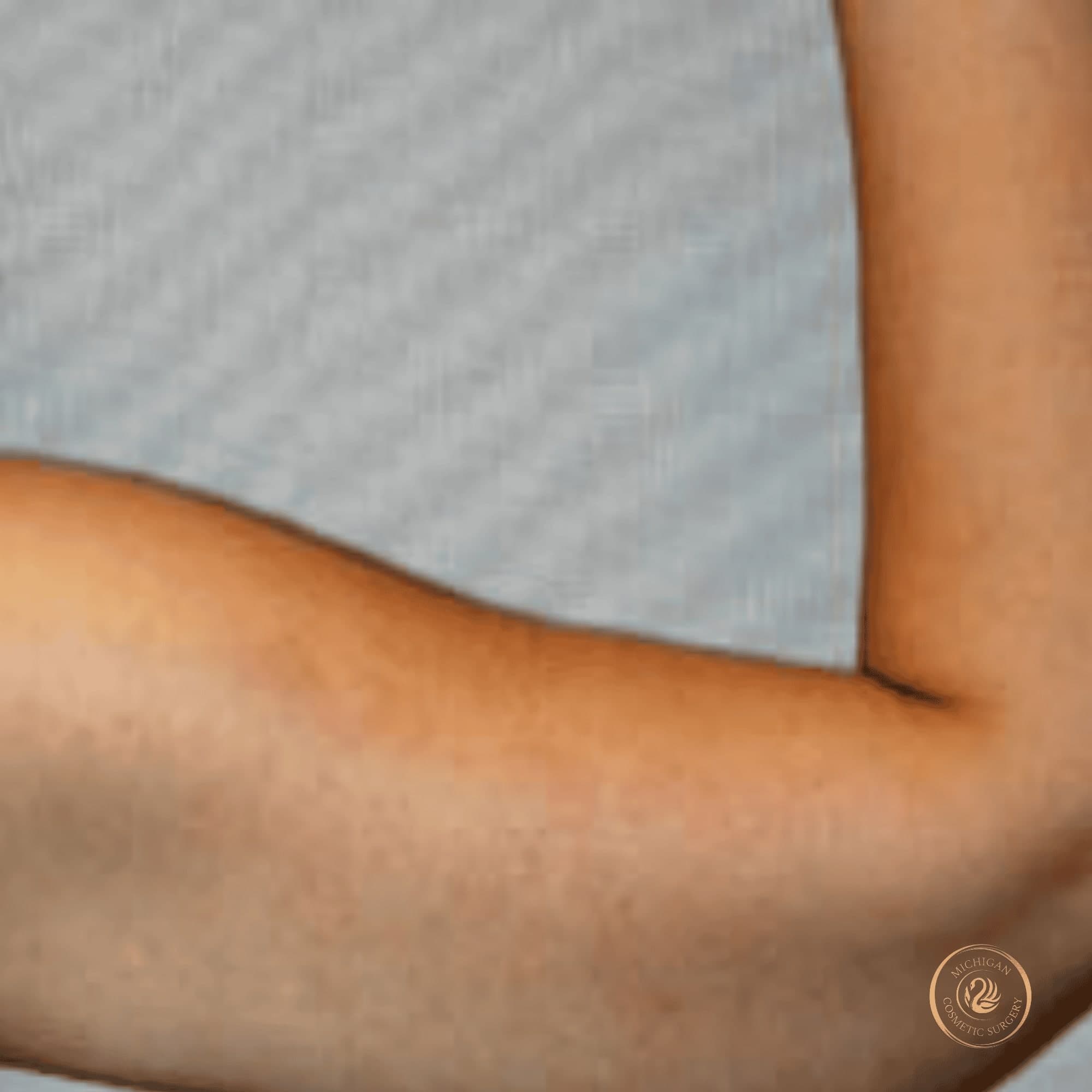 arm lift after photo by michigan cosmetic surgery in southfield mi