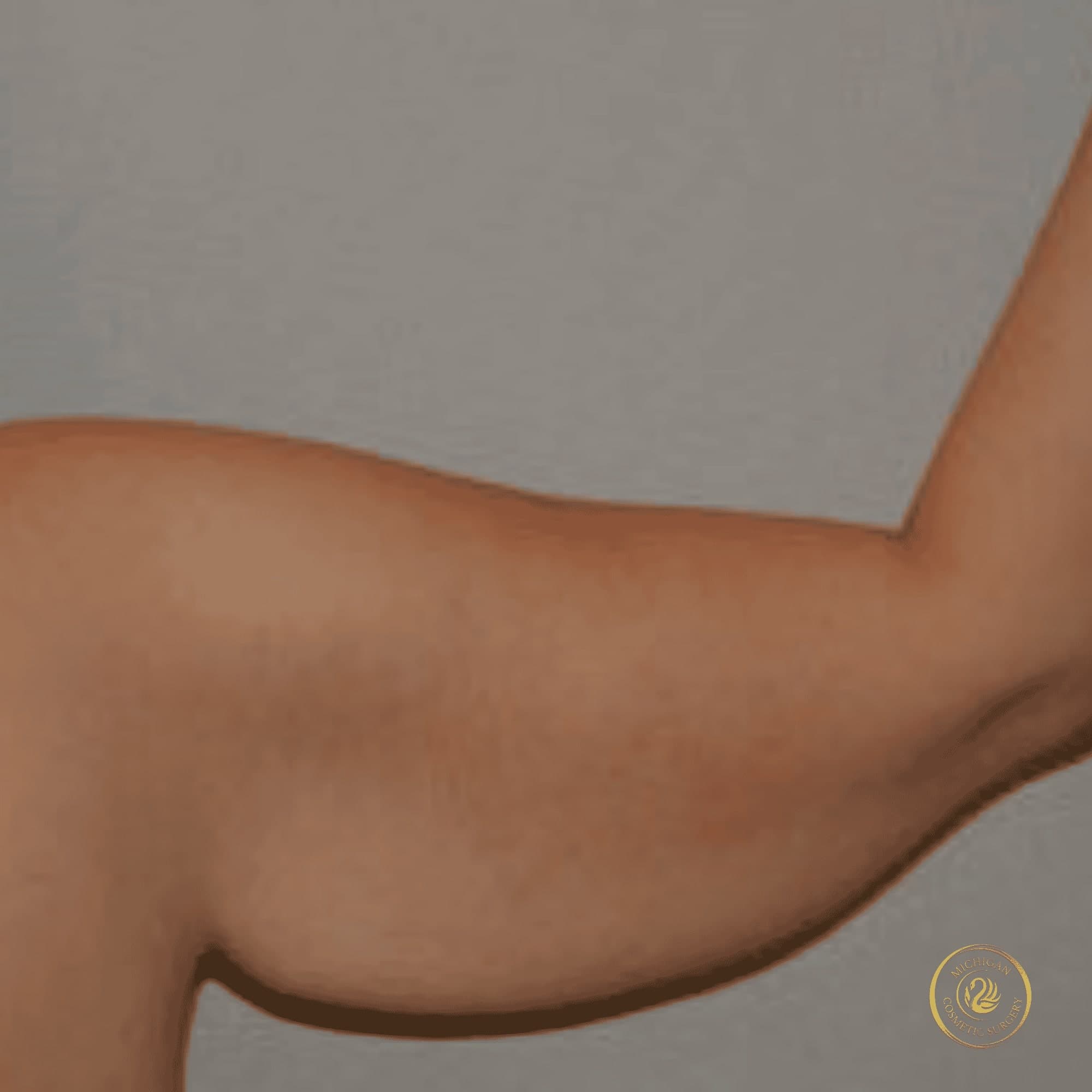 arm lift before photo by michigan cosmetic surgery in southfield mi
