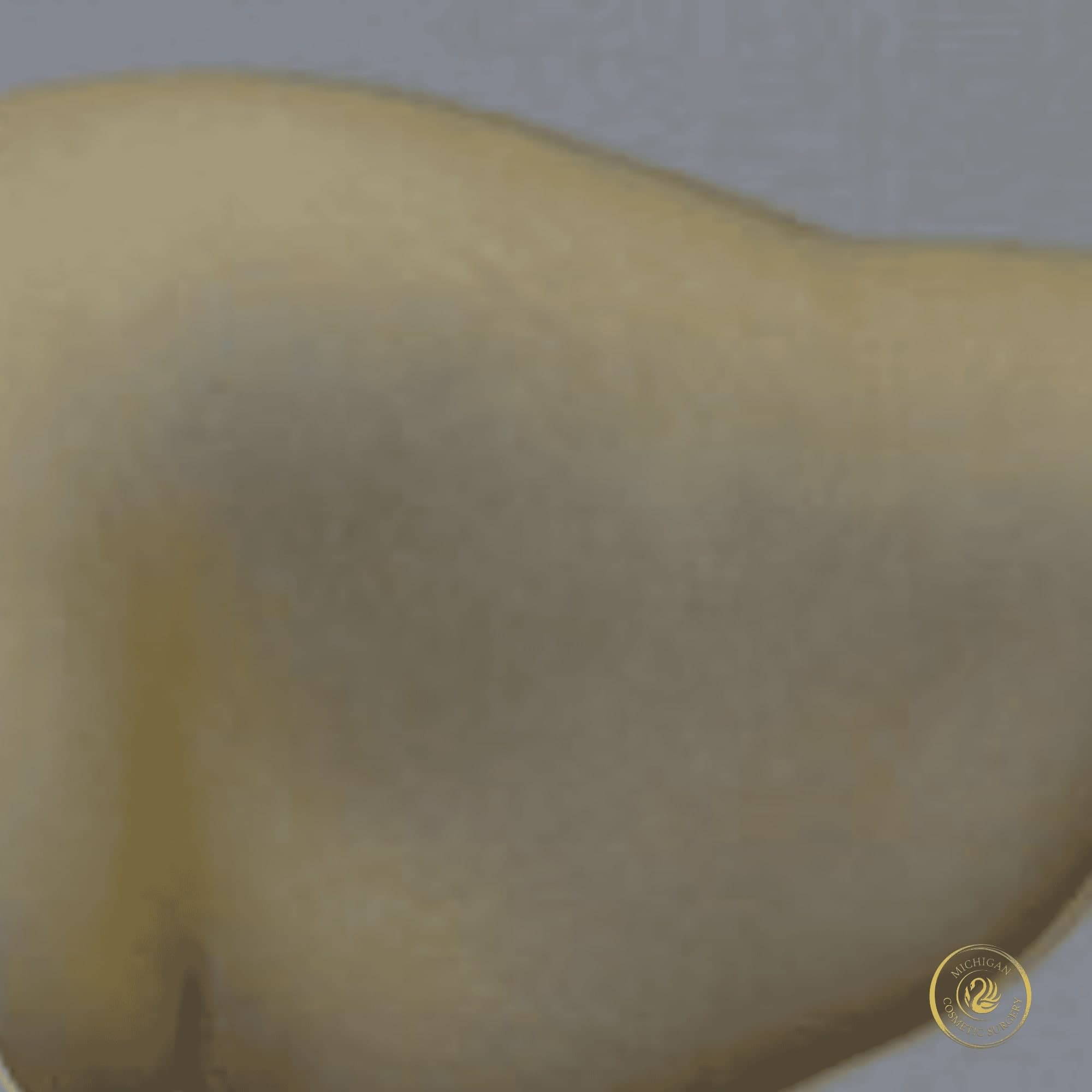 arm lift before photo by michigan cosmetic surgery in southfield mi