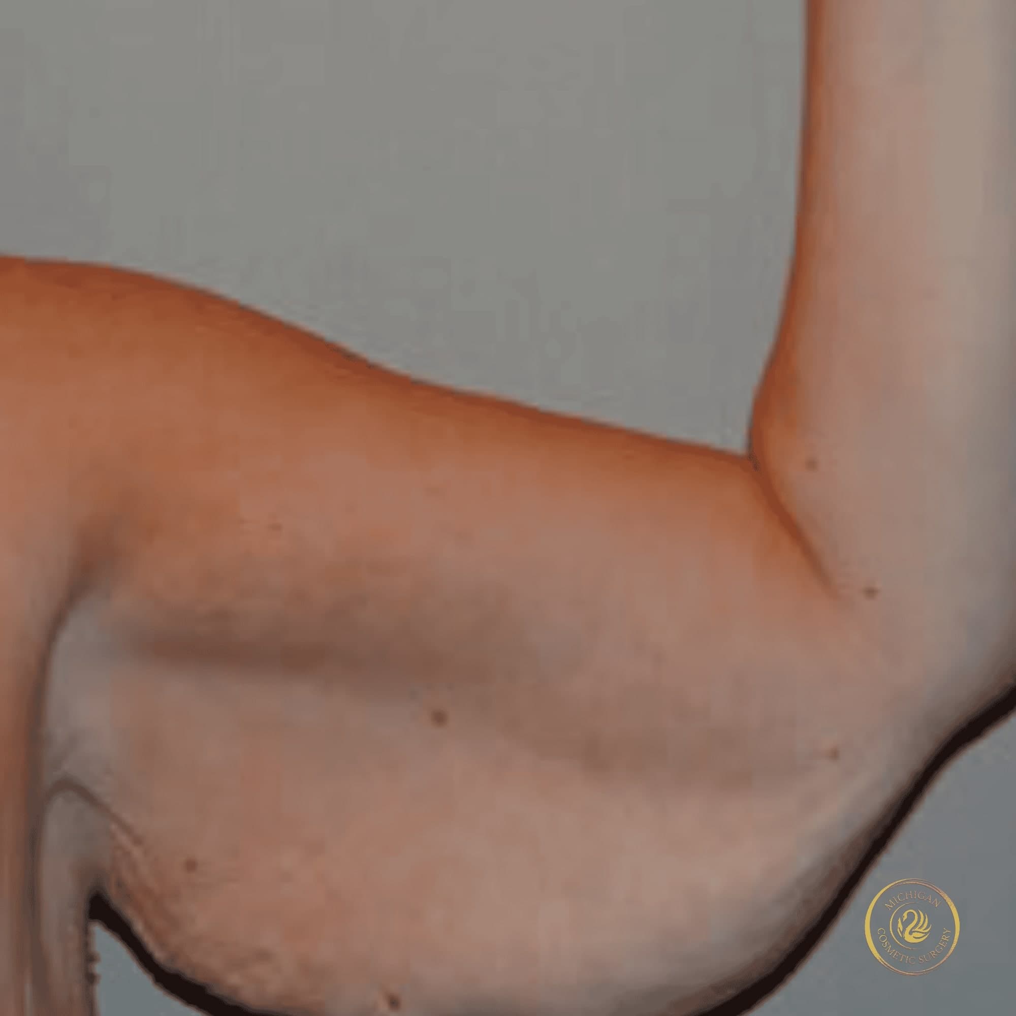 arm lift before photo by michigan cosmetic surgery in southfield mi