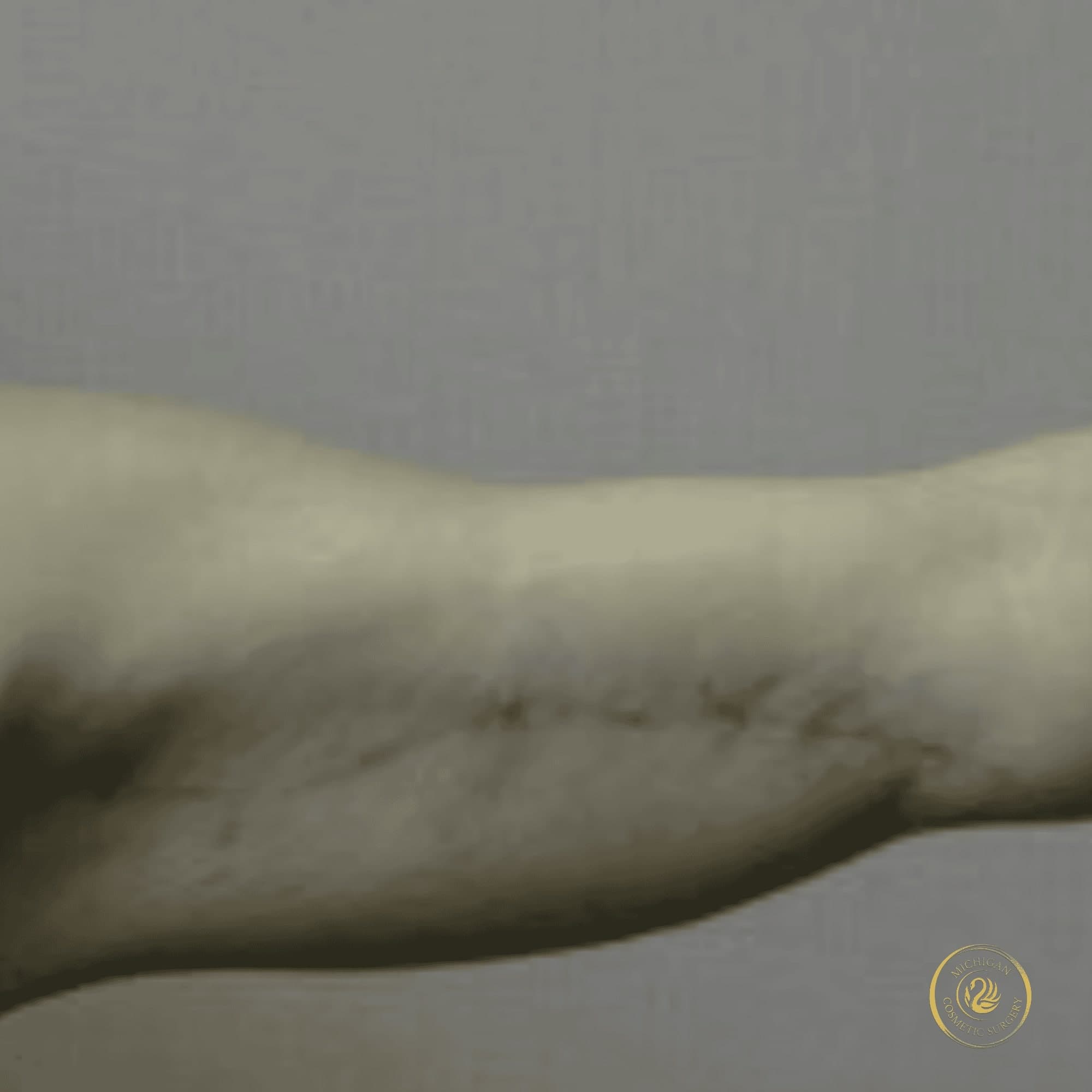 arm lift after photo by michigan cosmetic surgery in southfield mi